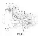 Fig. 02 - RECHARGEABLE PARTIALLY IMPLANTABLE HEARING INSTRUMENT