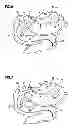 Fig. 05 - Obesity treatment and device