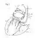 Fig. 02 - Method of Treating the Heart