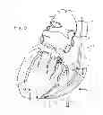 Fig. 04 - Method of Treating the Heart