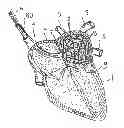 Fig. 01 - Apparatus and method for intra-cardiac mapping and ablation
