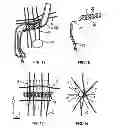 Fig. 02 - METHOD FOR NEUROMODULATION