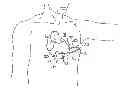 Fig. 01 - Methods for implanting a subcutaneous defibrillator