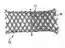 Fig. 01 - Disintegrating stent and method of making same