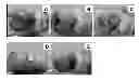 Fig. 01 - Method for regenerating hyaline cartilage