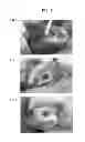 Fig. 06 - Method for regenerating hyaline cartilage