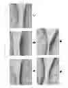 Fig. 22 - Method for regenerating hyaline cartilage