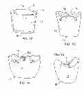 Fig. 07 - Method and apparatus for recording spatial gingival soft tissue relationship to implant placement within alveolar bone for immediate-implant placement
