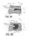 Fig. 07 - Bone treatment systems and methods