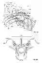 Fig. 06 - Elastic Guide Wire for Spinal Surgery