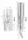 Fig. 32 - Endoscopic surgical clip applier