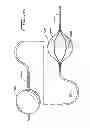 Fig. 10 - Rotational thrombectomy wire with blocking device