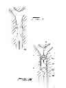 Fig. 13 - Rotational thrombectomy wire with blocking device