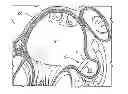 Fig. 01 - Occluding Device