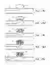 Fig. 09 - Detachable aneurysm neck bridge