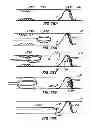 Fig. 43 - Methods for providing protection during procedures in the vasculature