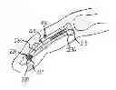 Fig. 01 - Bent dip fusion screw
