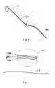 Fig. 02 - Implantable devices that generate low intensity electric fields for the treatment of atherosclerotic disease and prevention of ischemic vascular events and methods of manufacture