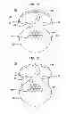 Fig. 05 - Implantable tissue stimulating electrode assembly