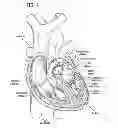 Fig. 02 - Rapidly deployable surgical heart valves