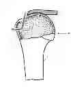 Fig. 01 - Arthroscopic method and apparatus for rotator cuff repair