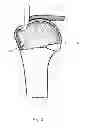 Fig. 04 - Arthroscopic method and apparatus for rotator cuff repair