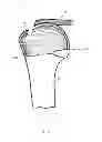 Fig. 06 - Arthroscopic method and apparatus for rotator cuff repair