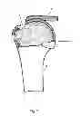 Fig. 08 - Arthroscopic method and apparatus for rotator cuff repair