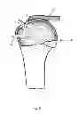 Fig. 09 - Arthroscopic method and apparatus for rotator cuff repair