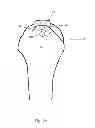 Fig. 22 - Arthroscopic method and apparatus for rotator cuff repair
