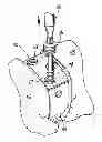 Fig. 01 - Orthopedic implants with flexible screws