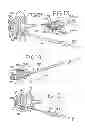 Fig. 04 - Spinal tissue distraction devices
