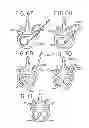 Fig. 22 - Spinal tissue distraction devices