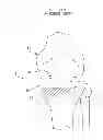 Fig. 01 - Method and apparatus for performing an open wedge, high tibial osteotomy