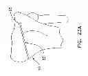 Fig. 32 - Method and apparatus for performing an open wedge, high tibial osteotomy