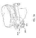 Fig. 43 - Method and apparatus for performing an open wedge, high tibial osteotomy