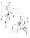 Fig. 46 - Method and apparatus for performing an open wedge, high tibial osteotomy