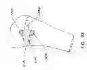 Fig. 47 - Method and apparatus for performing an open wedge, high tibial osteotomy