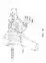 Fig. 48 - Method and apparatus for performing an open wedge, high tibial osteotomy