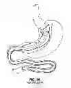 Fig. 02 - Endolumenal esophageal restriction device