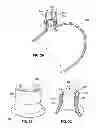 Fig. 06 - Endolumenal esophageal restriction device