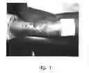 Fig. 02 - Method of treating acquired perforating dermatosis with cantharidin