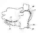Fig. 01 - Multi-bend steerable mapping catheter