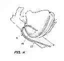 Fig. 04 - Multi-bend steerable mapping catheter