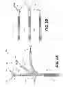 Fig. 04 - Medical device having a tensionable coupling