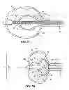 Fig. 09 - Balloon design to enhance cooling uniformity
