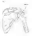 Fig. 02 - Method of humeral head resurfacing and/or replacement and system for accomplishing the method
