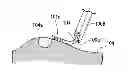 Fig. 01 - OVERCOAT TUBE