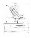 Fig. 09 - IMPLANTABLE FLOW CONNECTOR