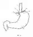 Fig. 02 - INTRALUMINAL DEVICES AND METHODS FOR DENERVATION